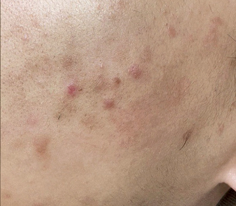 LINE_ALBUM_客照_250407_22 伊登蕾雅美學顧客案例